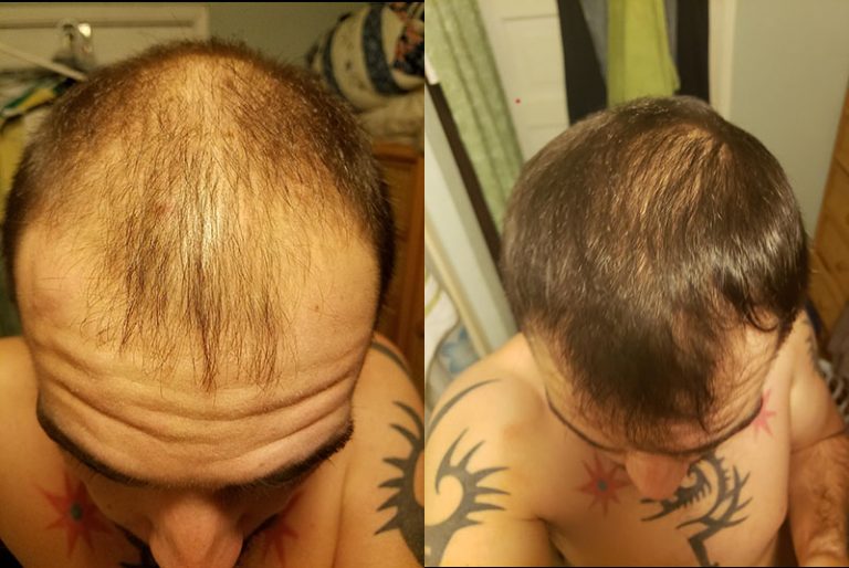 finasteride hair growth before and after